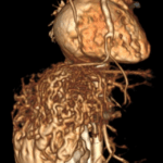 One-Day-Old Newborn Cured of Rare Liver Vascular Malformation Through Minimally Invasive Pinhole Procedure – The Hindustan Express